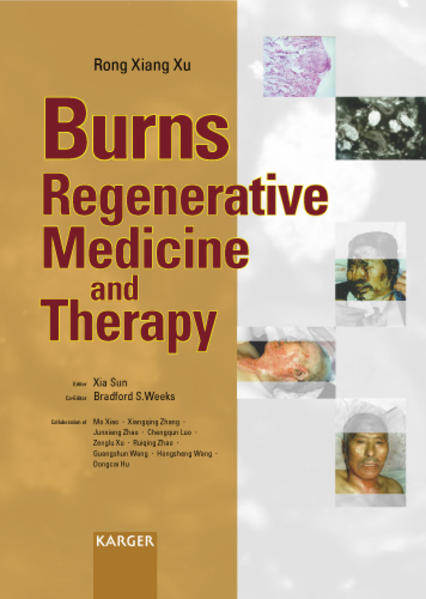 Sun, Xia, Bradford S. Weeks and Rong Xiang Xu:  Burns Regenerative Medicine and Therapy. 