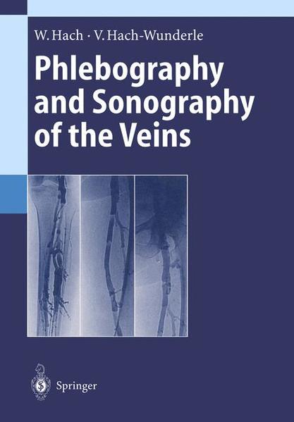 Hach, Wolfgang and Viola Hach-Wunderle:  Phlebography and Sonography of the Veins. 